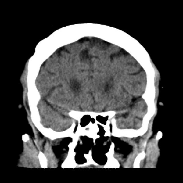 File:Brain cortical laminar necrosis (Radiopaedia 25822-25971 C 18).jpg