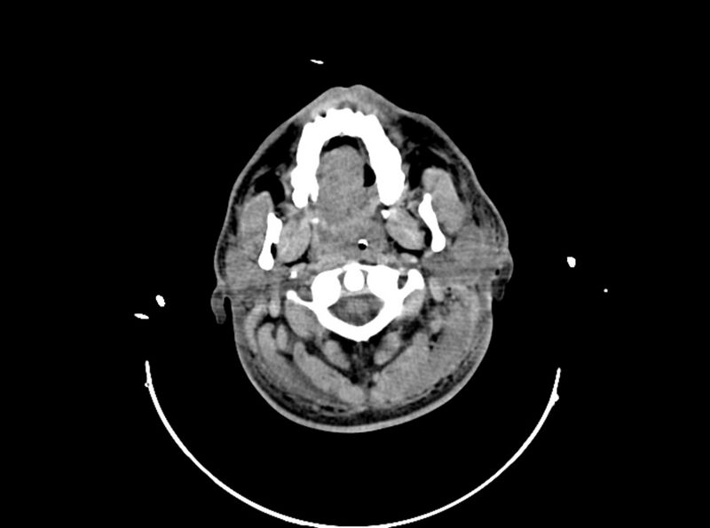 File:Brain injury by firearm projectile (Radiopaedia 82068-96087 B 27).jpg