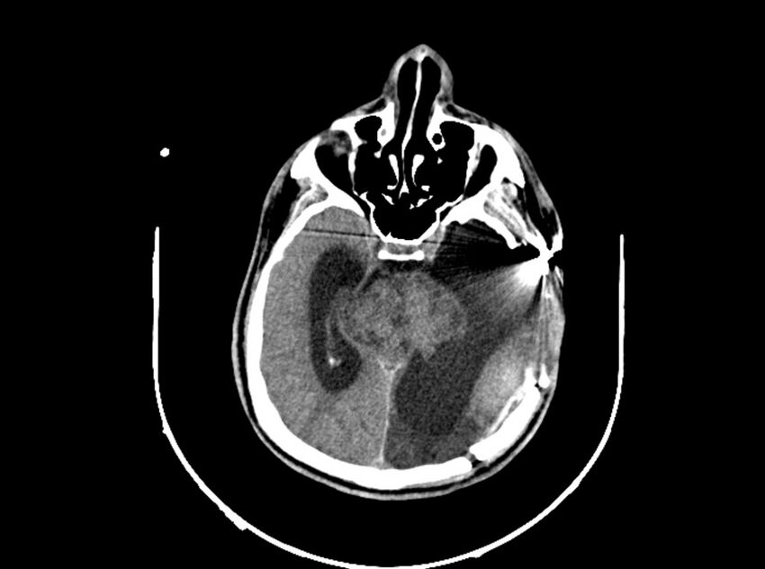 Brain injury by firearm projectile (Radiopaedia 82068-96088 A 114).jpg