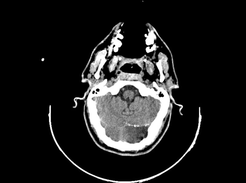File:Brain injury by firearm projectile (Radiopaedia 82068-96088 A 71).jpg
