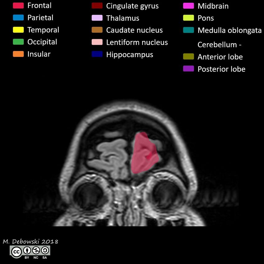 Brain lobes - annotated MRI (Radiopaedia 61691-69700 Coronal 2).JPG