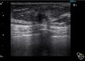 Breast cancer on ultrasound (Radiopaedia 15840-15491 B 1).jpg
