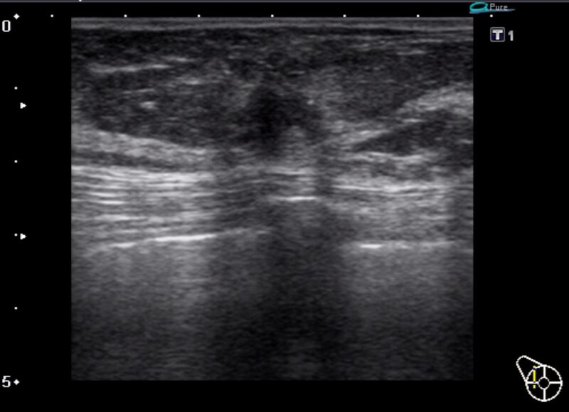 File:Breast cancer on ultrasound (Radiopaedia 15840-15491 B 1).jpg