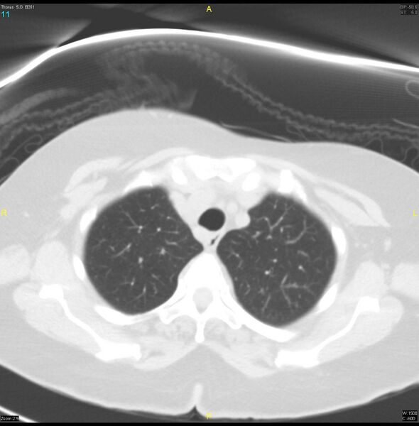 File:Breast primary with lung and bone metastases (Radiopaedia 40620-43228 Axial lung window 11).jpg