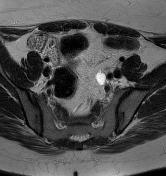 File:Broad ligament leiomyoma (Radiopaedia 81634-95516 Axial T2 6).jpg