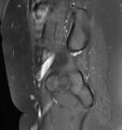 Broad ligament leiomyoma (Radiopaedia 81634-95516 G 26).jpg