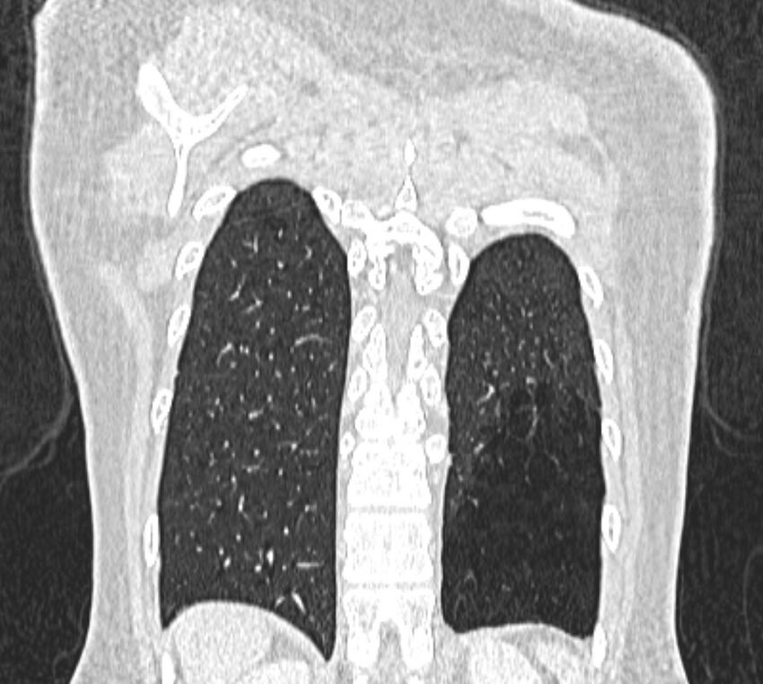 Bronchial atresia (Radiopaedia 50007-55297 Coronal lung window 102).jpg