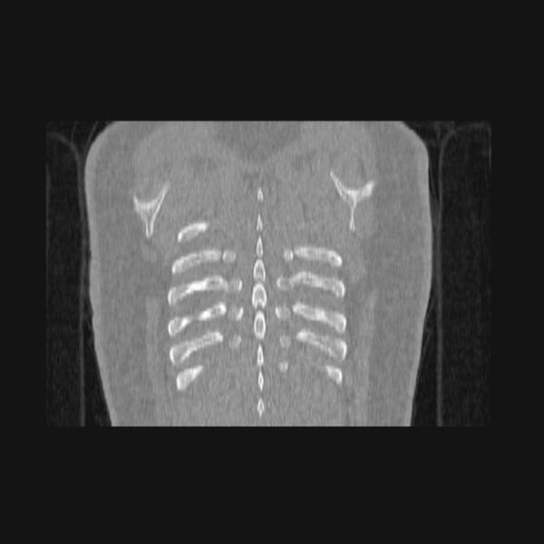 File:Bronchial atresia (Radiopaedia 60685-68439 Coronal lung window 4).jpg