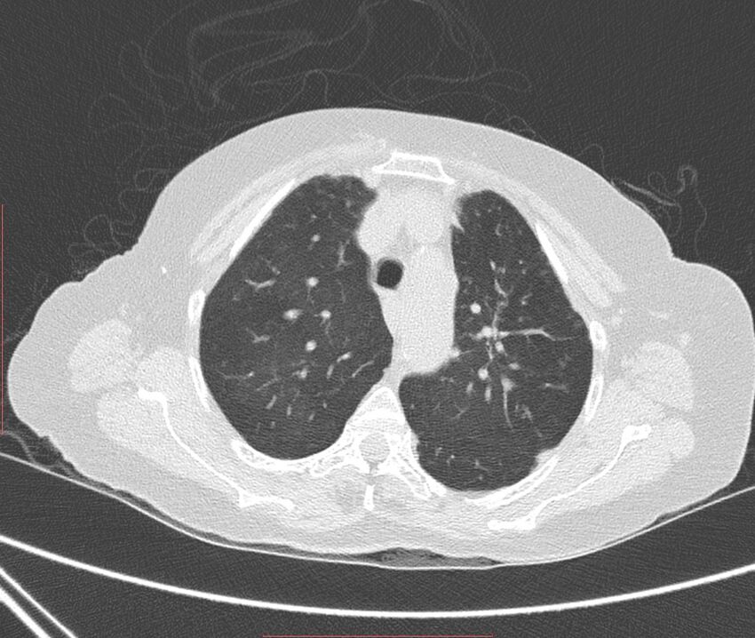 Bronchiectasis (Radiopaedia 72693-83293 Axial lung window 30).jpg