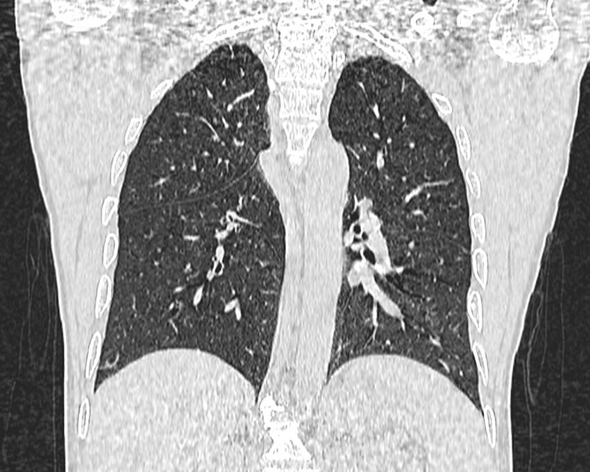 Bronchogenic carcinoma with superior vena cava syndrome (Radiopaedia 36497-38054 Coronal lung window 69).jpg