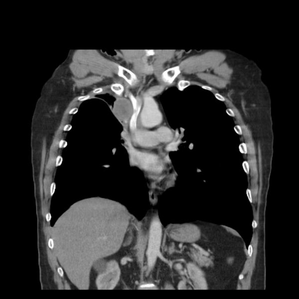 File:Bronchogenic carcinoma with upper lobe collapse (Radiopaedia 29297-29726 D 30).jpg