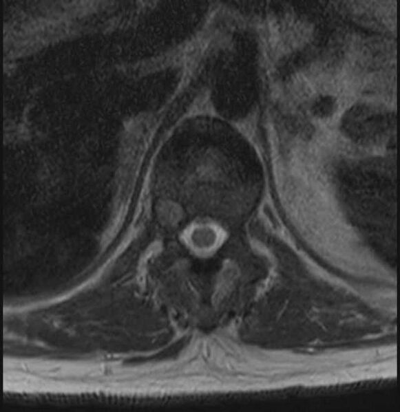 File:Brown tumors compressing the spinal cord (Radiopaedia 68442-78030 A 5).jpg