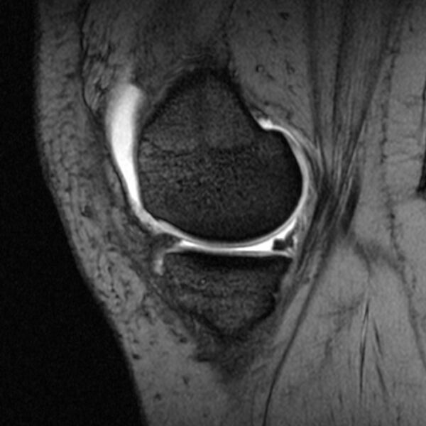 File:Bucket handle tear - medial meniscus (Radiopaedia 79028-91942 D 19).jpg