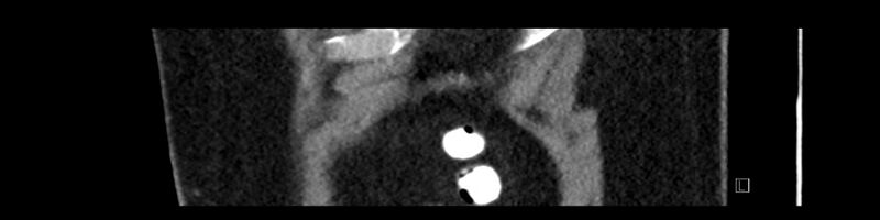 File:Buried bumper syndrome - gastrostomy tube (Radiopaedia 63843-72575 Sagittal Inject 9).jpg