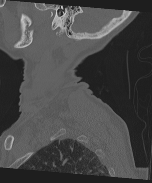 File:C2 fracture with vertebral artery dissection (Radiopaedia 37378-39199 Sagittal bone window 72).png