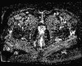 Cancer cervix - stage IIb (Radiopaedia 75411-86615 Axial ADC 4).jpg