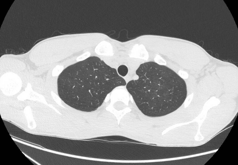 File:Cannabis-induced diffuse alveolar hemorrhage (Radiopaedia 89834-106946 Axial lung window 16).jpg