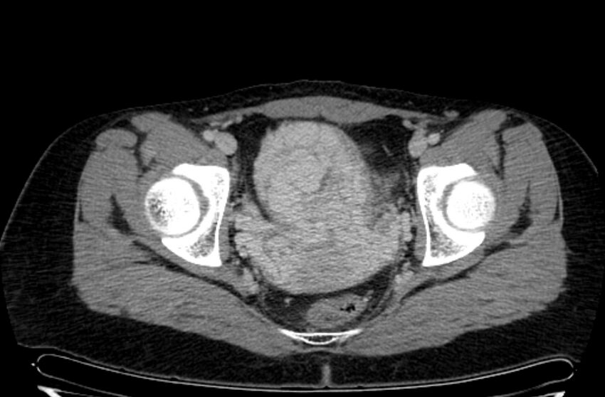 Cannonball metastases - uterine choriocarcinoma (Radiopaedia 70137-80174 A 39).jpg