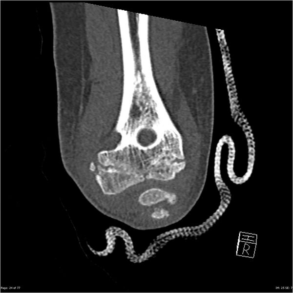 File:Capitellum fracture (Radiopaedia 23352-23426 Coronal bone window 24).jpg