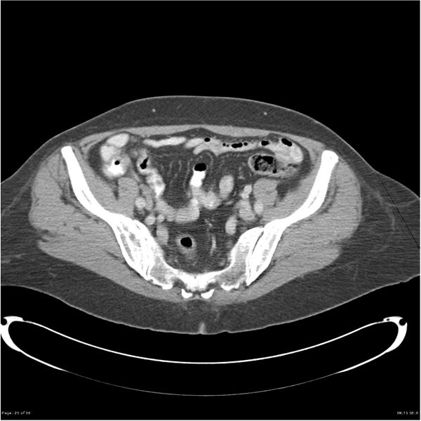 File:Carcinoid tumor of the ileum with metastasis to orbit (Radiopaedia 28165-28425 A 25).jpg