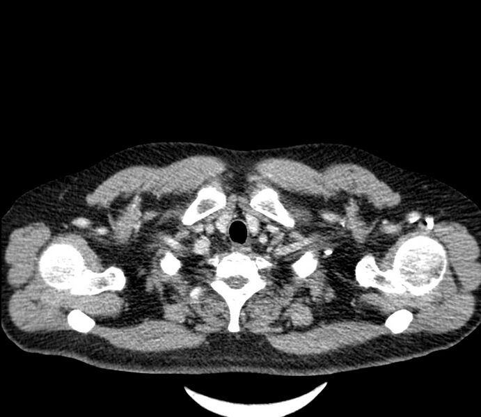 File:Carcinoid tumor with hepatic metastases (Radiopaedia 22651-22670 C 2).jpg