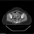 Carcinoma cervix- brachytherapy applicator (Radiopaedia 33135-34173 Axial non-contrast 24).jpg