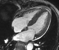 Cardiac amyloidosis (Radiopaedia 39736-42124 D 21).jpg