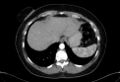 Cardiac sarcoidosis (Radiopaedia 74548-85534 A 77).jpg