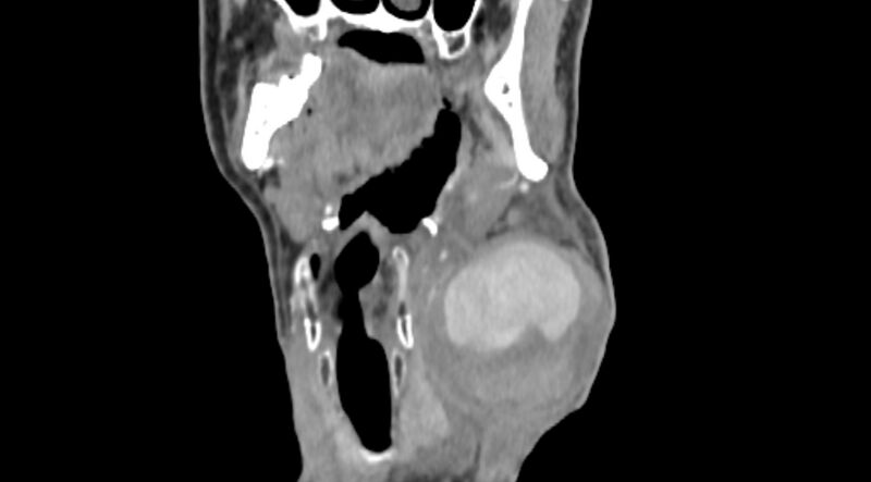 File:Carotid artery pseudoaneurysm (Radiopaedia 84030-99259 D 27).jpg