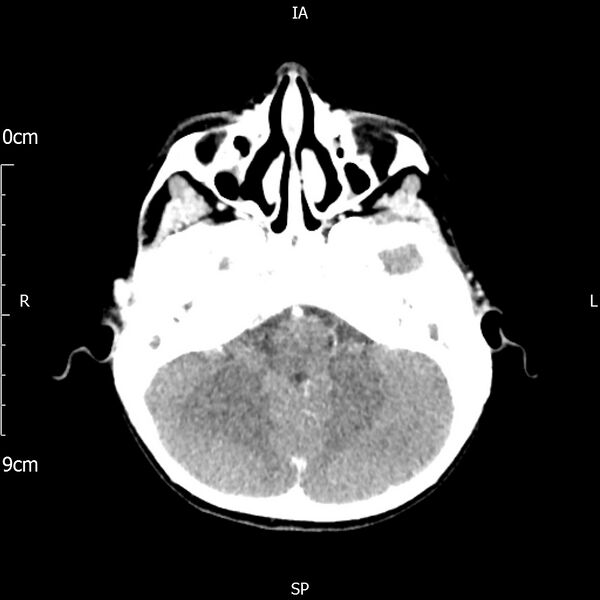 File:Cavernous sinus thrombosis (Radiopaedia 79414-92510 Axial Brain 65).jpg