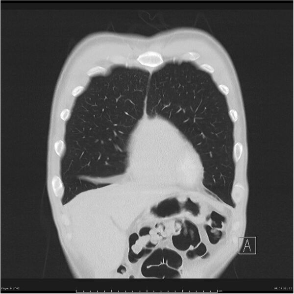 File:Cavitating lung cancer (Radiopaedia 25796-25945 lung window 6).jpg
