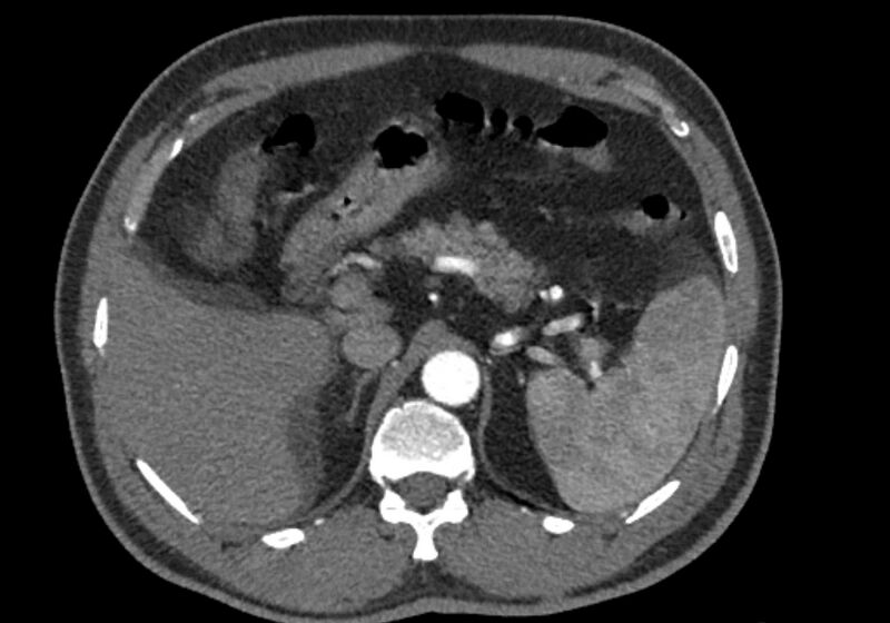 File:Celiac artery dissection (Radiopaedia 52194-58080 A 23).jpg