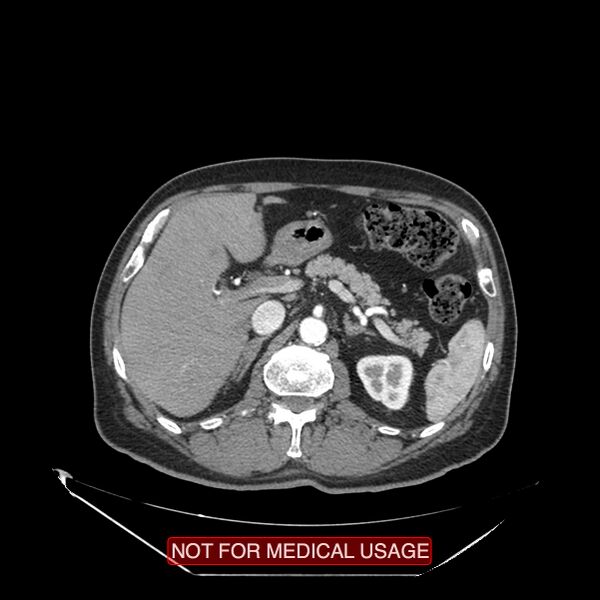 File:Celiac trunk variant anatomy - gastrohepatic trunk and splenic artery (Radiopaedia 38815-40995 A 25).jpg