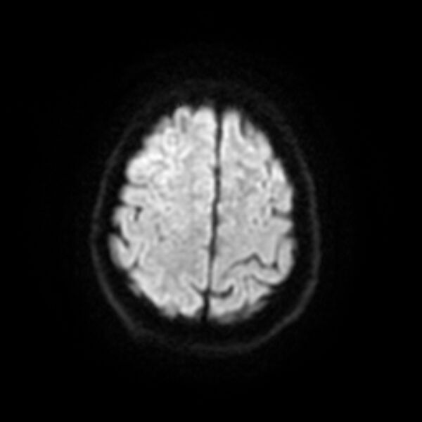File:Central neurocytoma (Radiopaedia 67618-77021 Axial DWI 19).jpg