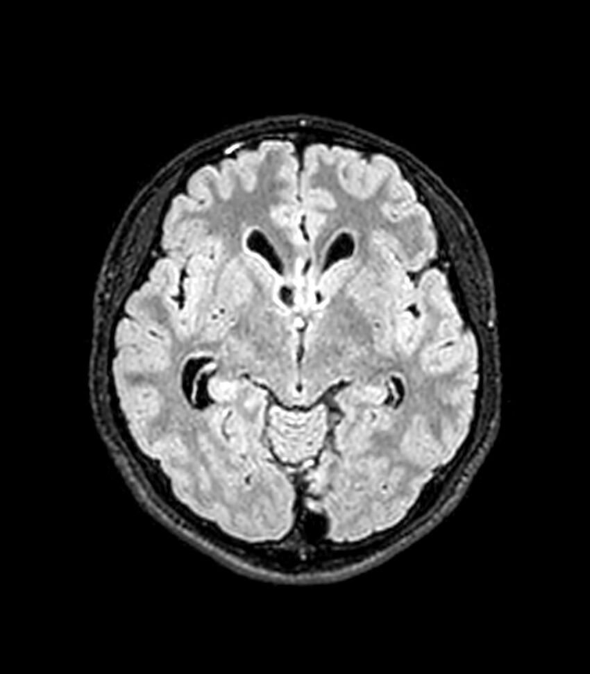 Central neurocytoma (Radiopaedia 79320-92380 Axial FLAIR 178).jpg