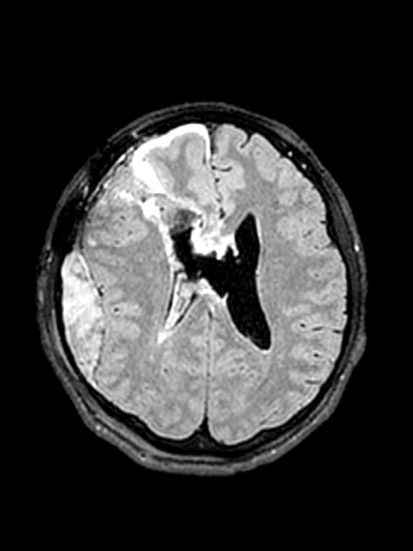 Central neurocytoma (Radiopaedia 79320-92381 Axial FLAIR 70).jpg