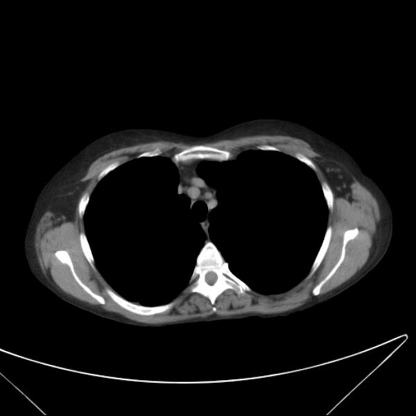 File:Centrilobular pulmonary emphysema (Radiopaedia 24495-24789 Axial non-contrast 12).jpg
