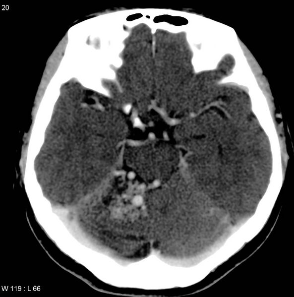File:Cerebellar arteriovenous malformation (Radiopaedia 5220-36607 A 7).jpg