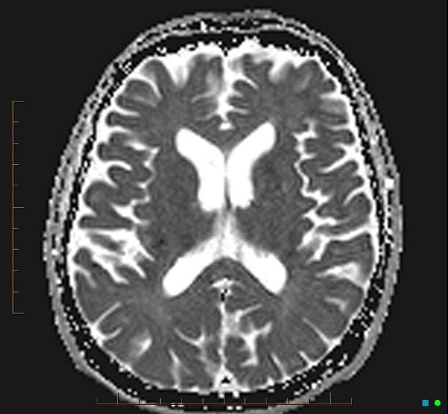 File:Cerebellar gangliocytoma (Radiopaedia 65377-74422 Axial ADC 22).jpg