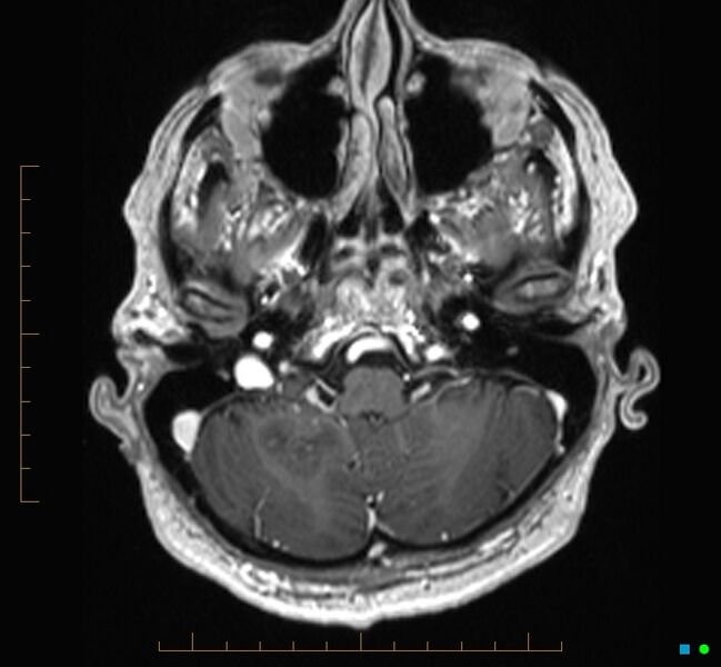 File:Cerebellar gangliocytoma (Radiopaedia 65377-74422 Axial T1 C+ 16).jpg