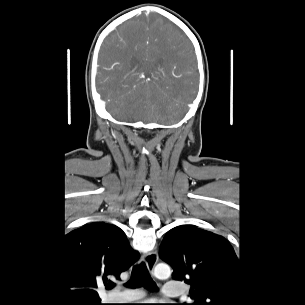File:Cerebellar infarct due to vertebral artery dissection with posterior fossa decompression (Radiopaedia 82779-97029 D 44).png