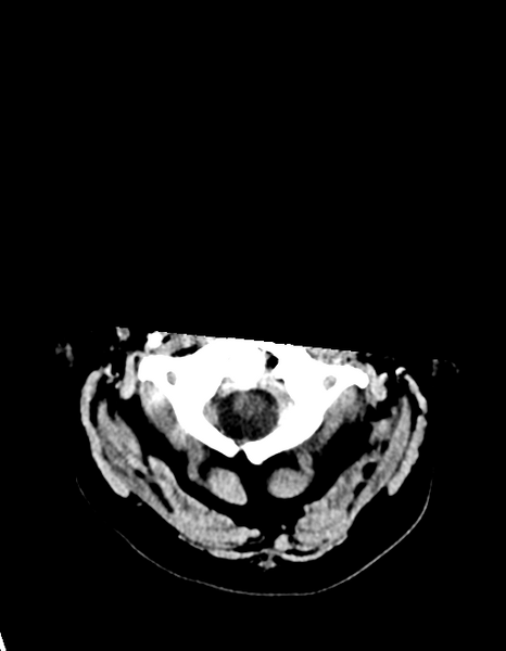 File:Cerebellar infarct due to vertebral artery dissection with posterior fossa decompression (Radiopaedia 82779-97030 Axial non-contrast 2).png