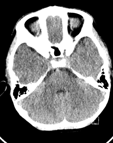 File:Cerebellar stroke (Radiopaedia 32202-33149 Axial non-contrast 5).png
