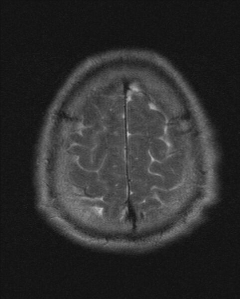File:Cerebellopontine angle meningioma (Radiopaedia 24459-24764 Axial T2 21).jpg