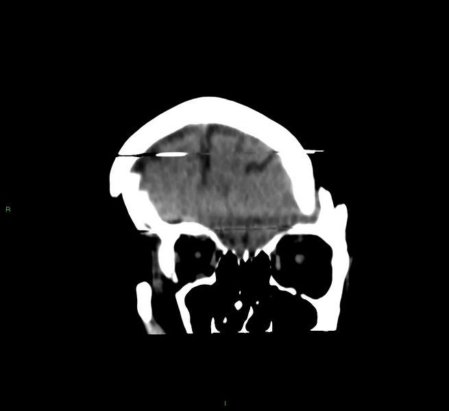 File:Cerebral amyloid angiopathy-associated lobar intracerebral hemorrhage (Radiopaedia 58377-65514 Coronal non-contrast 53).jpg