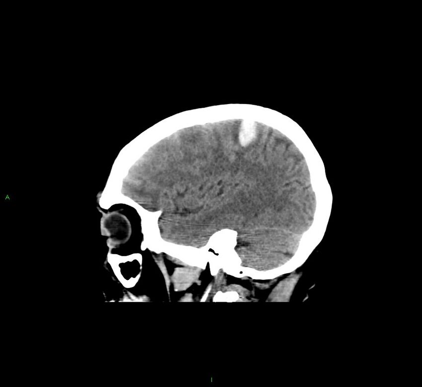 Cerebral amyloid angiopathy-associated lobar intracerebral hemorrhage (Radiopaedia 58529-65681 B 37).jpg