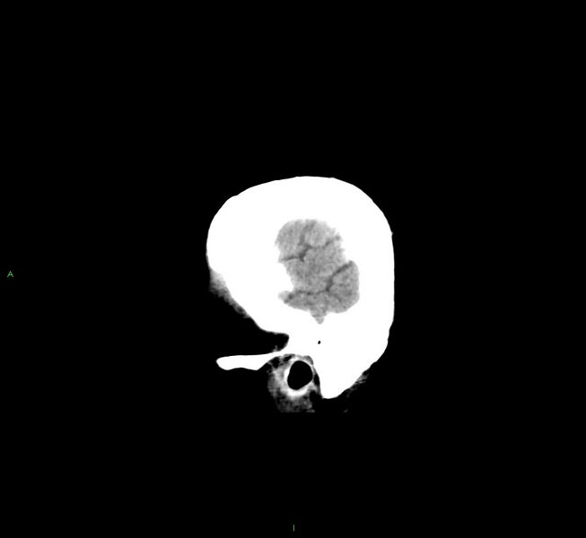 File:Cerebral amyloid angiopathy-associated lobar intracerebral hemorrhage (Radiopaedia 58529-65681 B 5).jpg