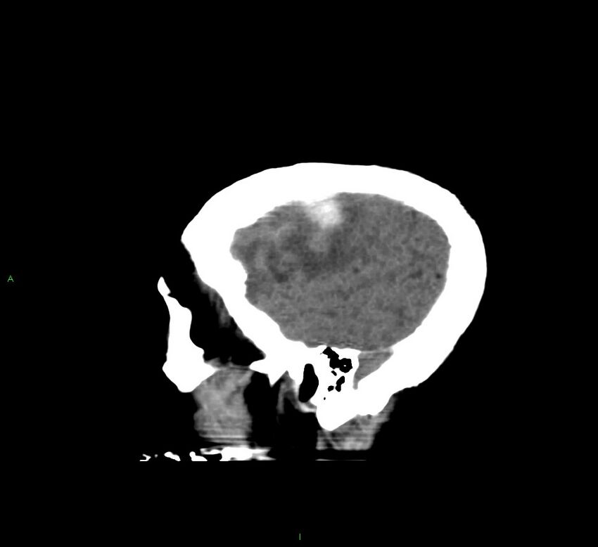 Cerebral amyloid angiopathy-associated lobar intracerebral hemorrhage (Radiopaedia 58560-65723 C 8).jpg