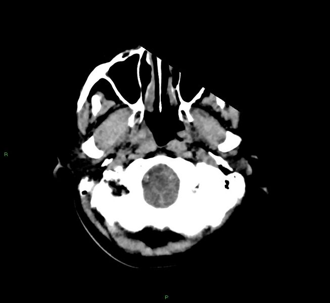 File:Cerebral amyloid angiopathy-associated lobar intracerebral hemorrhage (Radiopaedia 58566-65730 Axial non-contrast 46).jpg