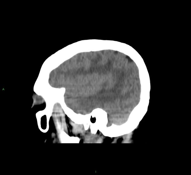 File:Cerebral amyloid angiopathy-associated lobar intracerebral hemorrhage (Radiopaedia 58751-65972 C 42).jpg